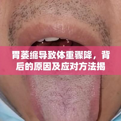 胃萎缩导致体重骤降，背后的原因及应对方法揭秘